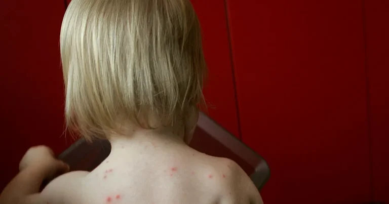 Klart: Gratis vattkoppsvaccin för barn
