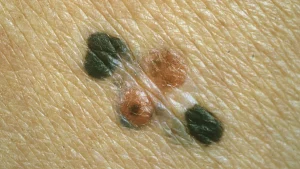 Här är titeln översatt till svenska:
”Moderna-aktier rusar efter positiv melanomvaccinstudie”
Alternativt, något mer nyhetsartikel-liknande:
”Moderna rusar på börsen efter positivt besked om melanomvaccin”