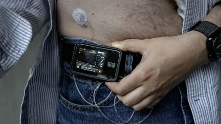 Här är en omskrivning av rubriken på svenska:
Genombrott i typ 1-diabetes: Patient får genmodifierade insulinceller utan immunsuppressiva läkemedel
(Alternativt, något kortare:)
Genombrott för typ 1-diabetes: Genmodifierade insulinceller utan immunsuppressiva